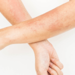 How to Get Rid of Contact Dermatitis Fast and Permanently